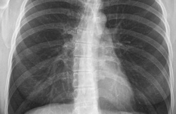 Röntgenbild des Thorax