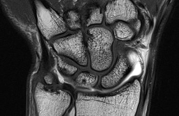 MRI des Handgelenks