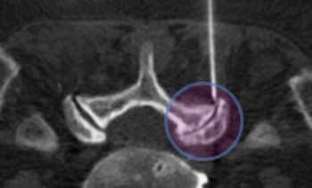 CT-gesteuerte Facettengelenksinfiltration