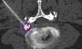 CT-gesteuerter Nervenwurzelblock