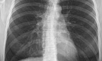 Röntgenbild des Thorax