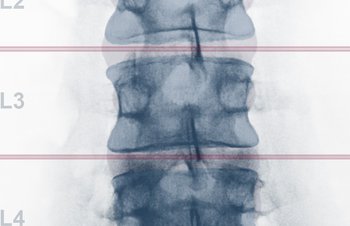 Osteodensitometrie (DEXA)