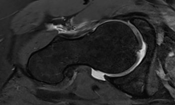 MRI des rechten Hüftgelenks