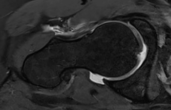 MRI des rechten Hüftgelenks