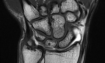 MRI des Handgelenks