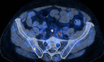 PSMA PET/CT